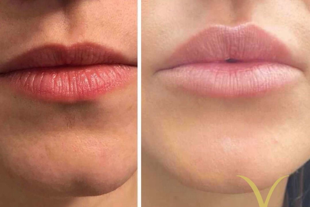 Realizar el tratamiento de aumento de labios en la Clínica Yasmin