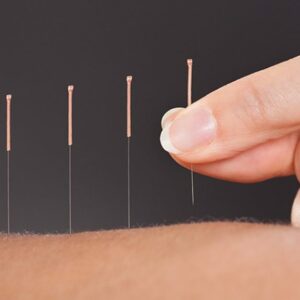 La acupuntura y sus ventajas para disfrutar de una mayor salud y equilibrio