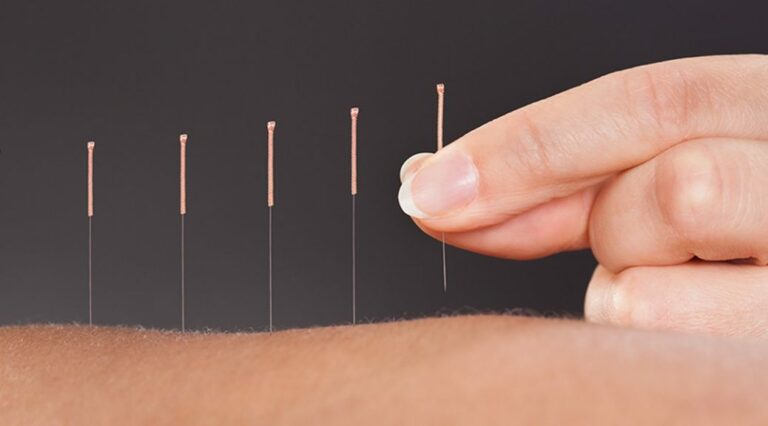 La acupuntura y sus ventajas para disfrutar de una mayor salud y equilibrio