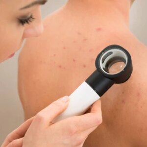 ¿Qué es la Psoriasis?  Cura - Remedios efectivos