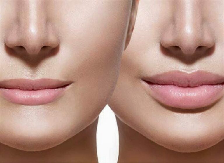 ¿Cuándo es necesaria una queiloplastia?