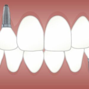 Qué tipos de implantes existen y cómo diferenciarlos