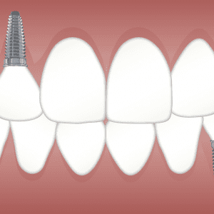 Qué tipos de implantes existen y cómo diferenciarlos