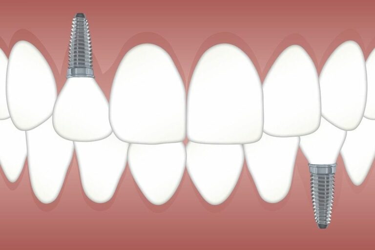 Qué tipos de implantes existen y cómo diferenciarlos