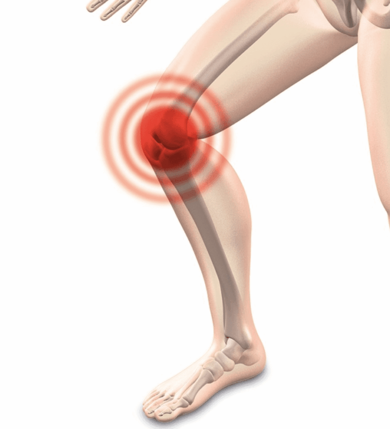 Formas de prevenir la artrosis