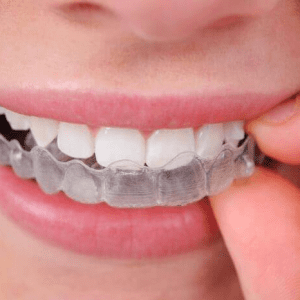 Invisalign, la nueva tendencia en tratamientos con ortodoncia
