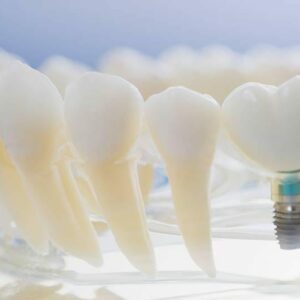 Ventajas de los implantes dentales