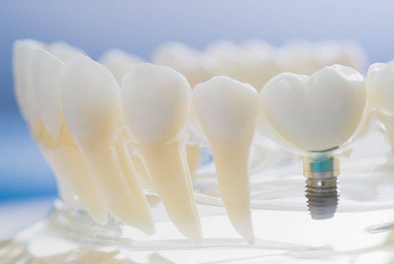 Ventajas de los implantes dentales