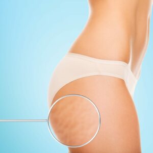 Consejos para reducir naturalmente la celulitis