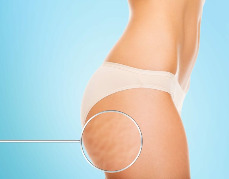Consejos para reducir naturalmente la celulitis
