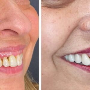 Todo lo que hay que saber acerca de las carillas dentales, por Dentinova