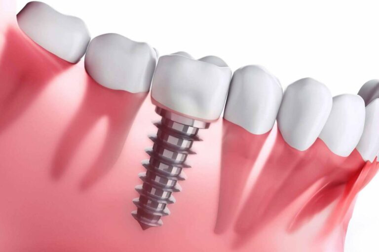 Clínica Dental Ahoa y la implantología dental de carga inmediata
