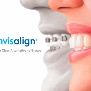 Ortodoncia invisible Invisalign, la tecnología que garantiza estética y comodidad