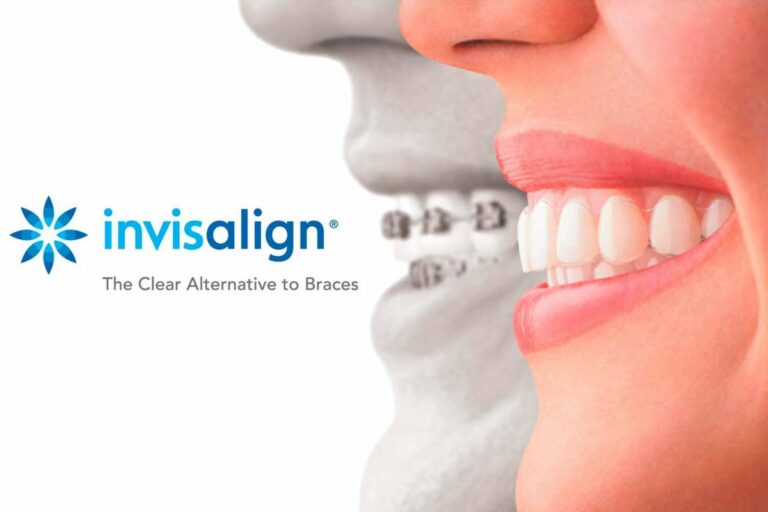 Ortodoncia invisible Invisalign, la tecnología que garantiza estética y comodidad