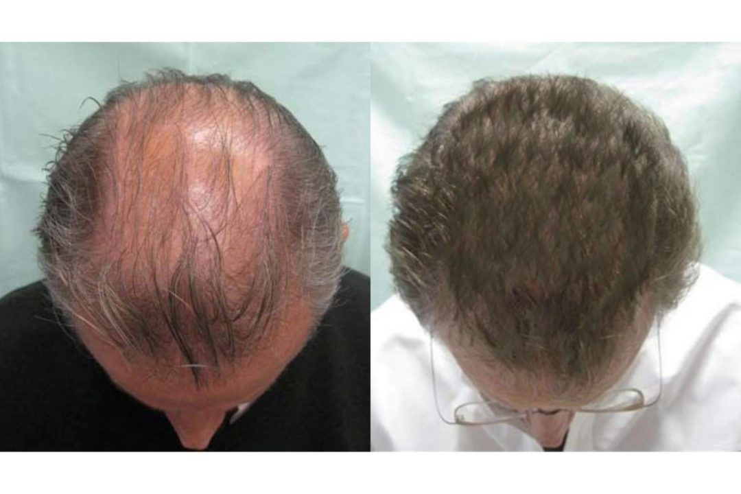 Tratamientos Efectivos Para Alopecia Androgenética En La Clínica ...