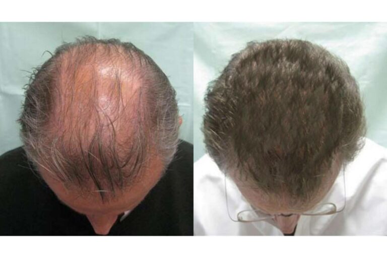 Tratamientos efectivos para alopecia androgenética en la clínica capilar Innovación Capilar