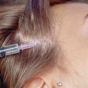 ¿En qué consiste la mesoterapia capilar y cuáles son sus efectos y recuperación?, por Élite Capilar