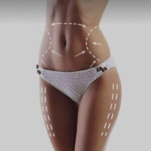 La mesoterapia corporal es el tratamiento de grasa localizada y celulitis ofrecido por la clínica de la Dra. Sánchez-Peral