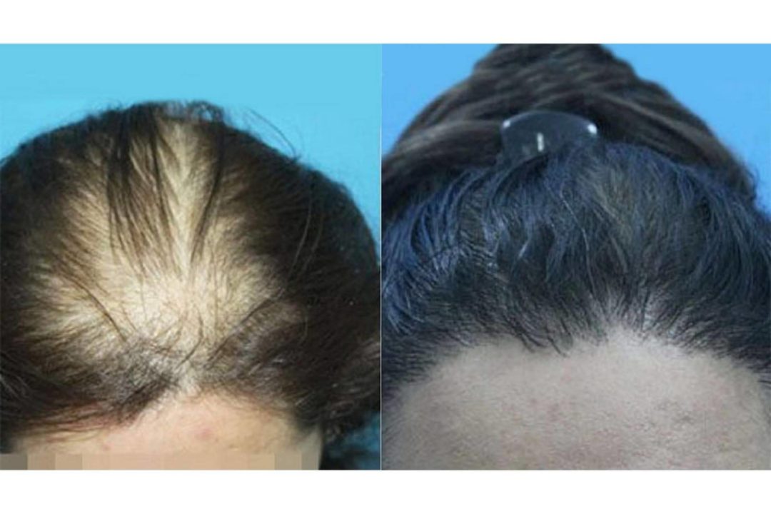 Trasplante capilar para mujeres que sufren alopecia femenina, por la clínica Innovación Capilar