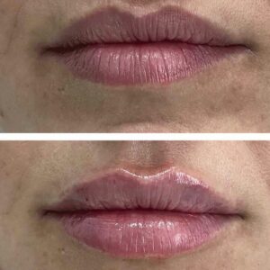 La técnica, Adiblips, de la Clínica Yasmin para el aumento de labios con ácido hialurónico