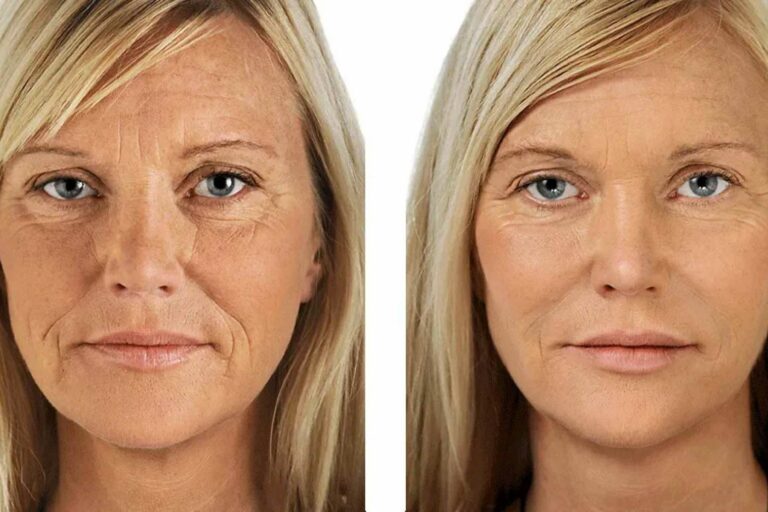 KōAN Club lleva a cabo el PRP facial para combatir los signos de envejecimiento