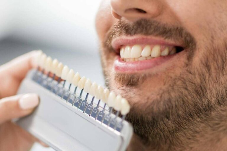 Todo lo que se debe saber acerca de las carillas dentales, según Crespí & Gandía