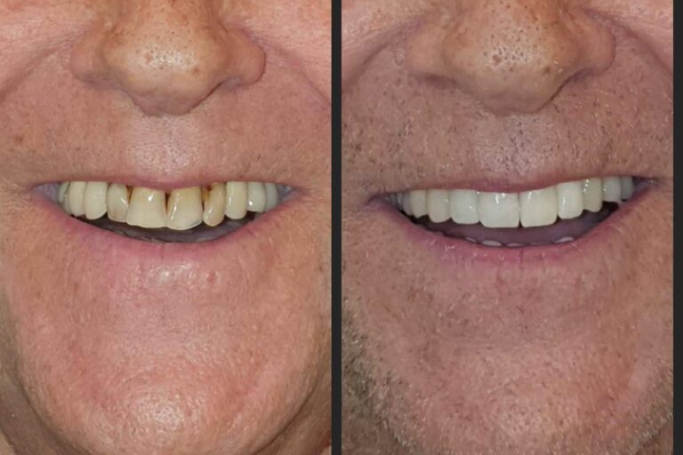 Tratamiento de alineación dentaria sin ortodoncia, por Dentinova