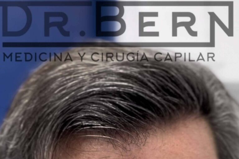 Dr. Bern, premiado por perfeccionar la técnica FUE - DHI y llevar su técnica a distintas partes de Latinoamérica y Europa