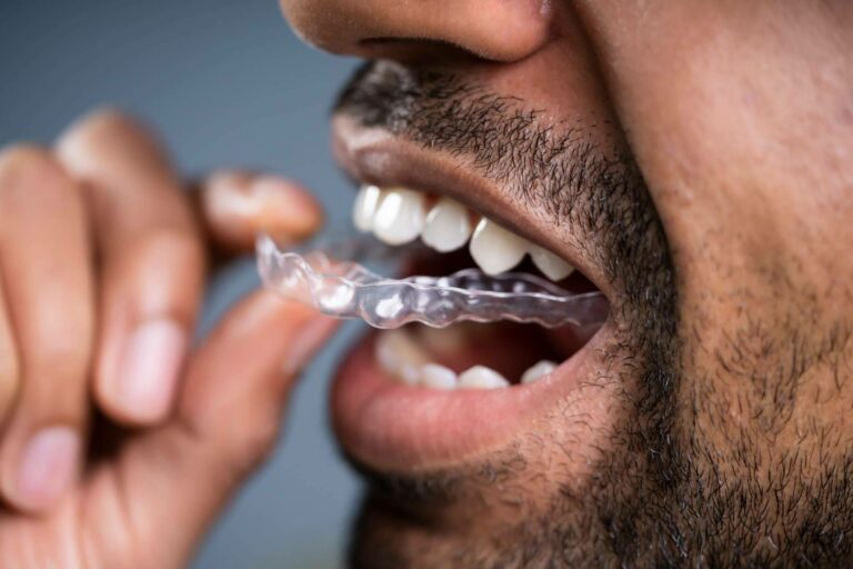 Clínicas Dental Bell y los principales beneficios de la ortodoncia invisible