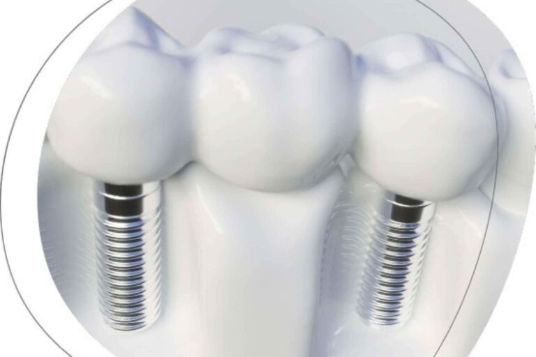 La Clínica Dental Agudo Rosa de Albacete cuenta con expertos en implantes dentales