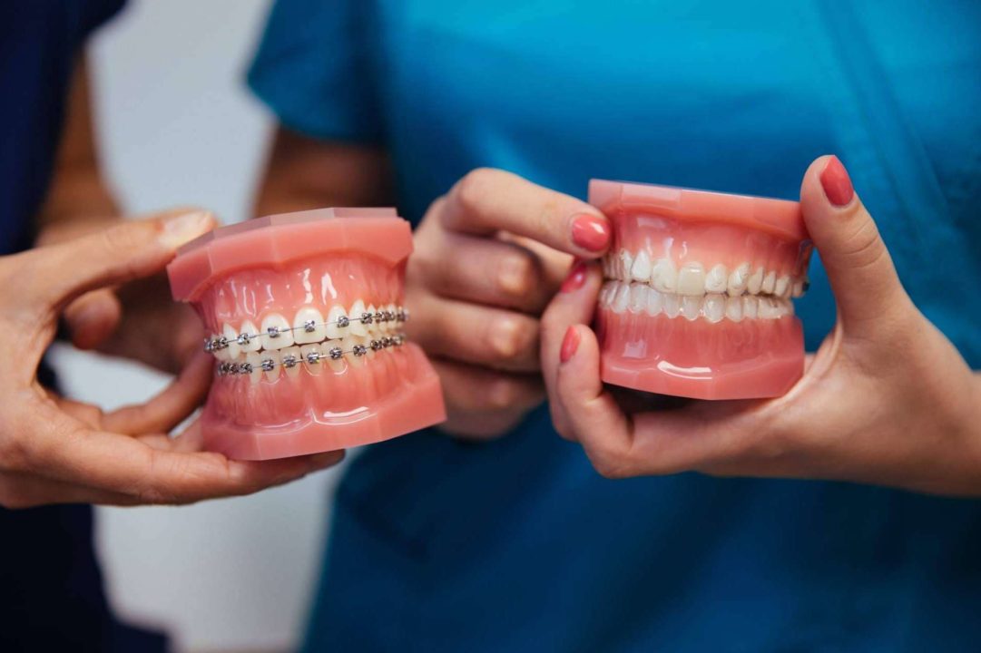 5 Ventajas De La Ortodoncia Invisible Invisalign Frente A Los Brackets Por Dientes Redondos 