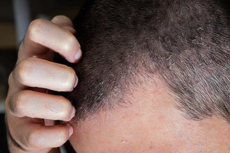 Dermatitis seborreica, una afección que puede provocar alopecia si no se trata