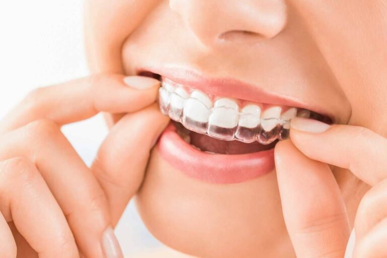 Corregir la sonrisa de forma estética con Invisalign en Sevilla, de la mano de Clínicas Dental Bell
