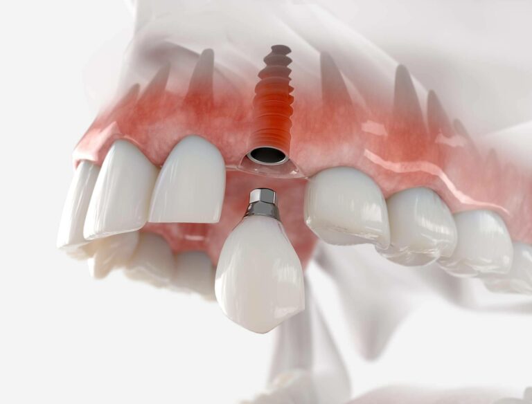 Dentinova, las consecuencias de la pérdida de un diente