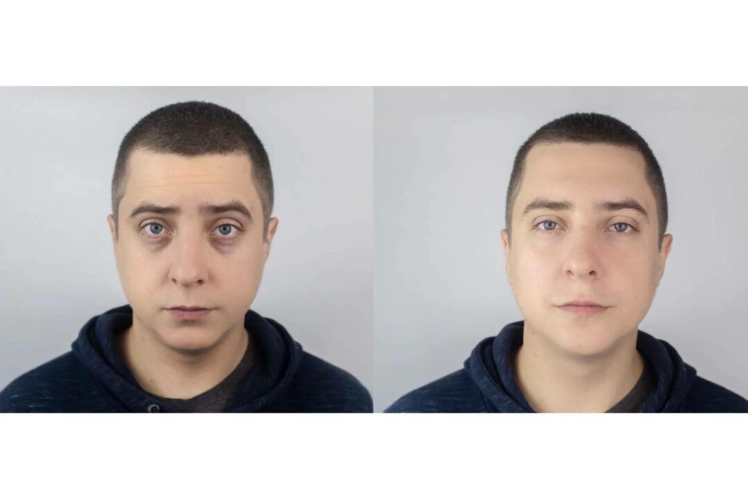 Centro Estética El Pilar ayuda a combatir las ojeras con el tratamiento no invasivo de ácido hialurónico