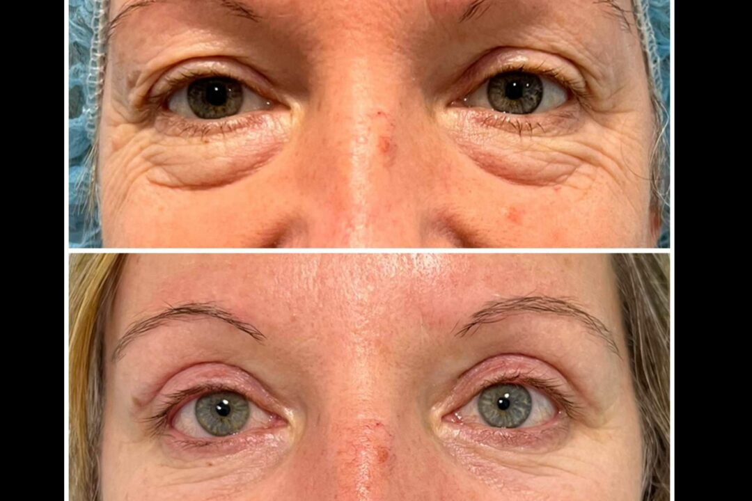 Blefaroplastia, el tratamiento indicado para rejuvenecer la mirada, por Clínica Jiménez Ortiz