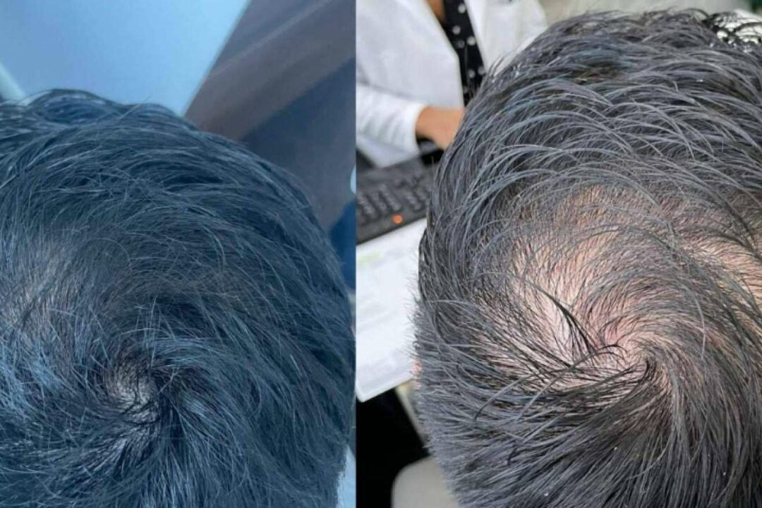 Immunotherapy Regenerative Medicine ofrece tratamientos de medicina regenerativa para el cabello con células madre y plasma rico en plaquetas