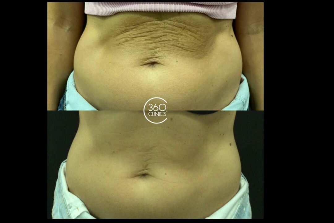 El tratamiento revolucionario para combatir flacidez y celulitis en 360 Clinics