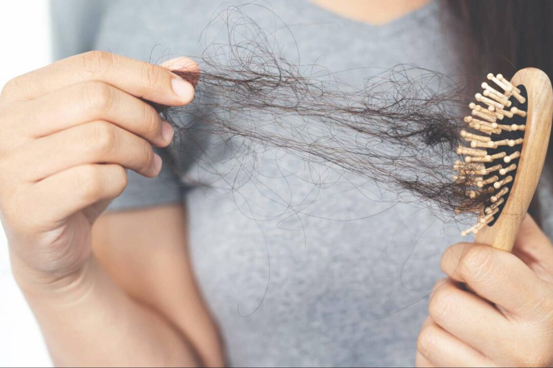 Alopecia androgénica; causas, tratamientos y cómo recuperar la confianza