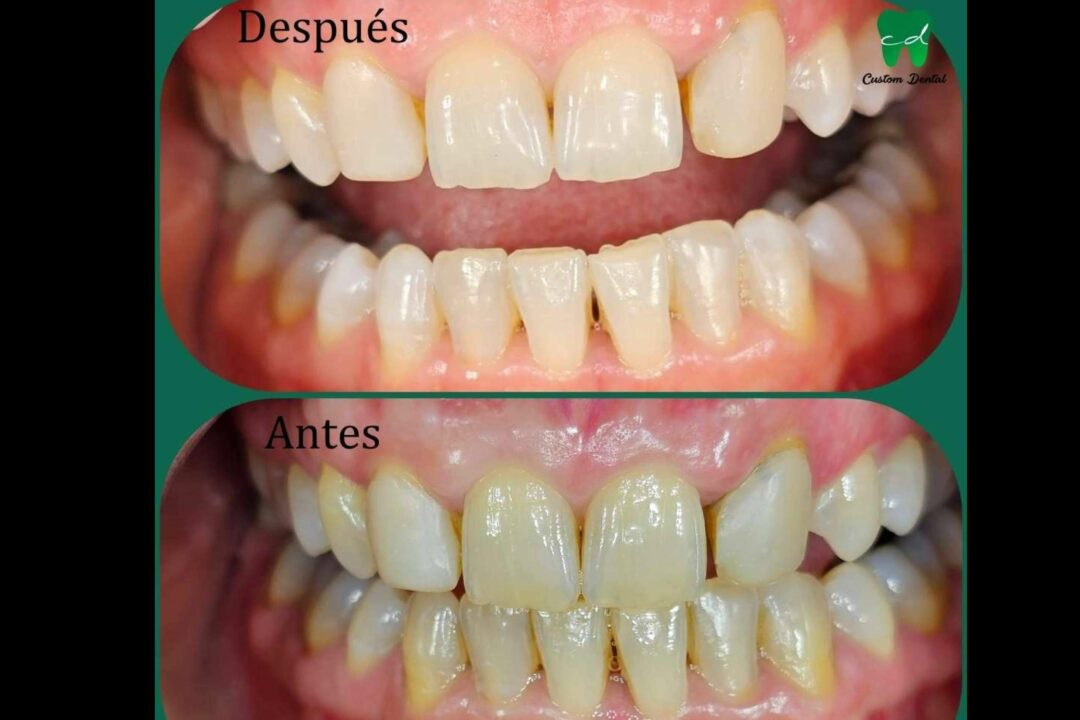 La importancia de una sonrisa radiante; Blanqueamiento dental en dos citas