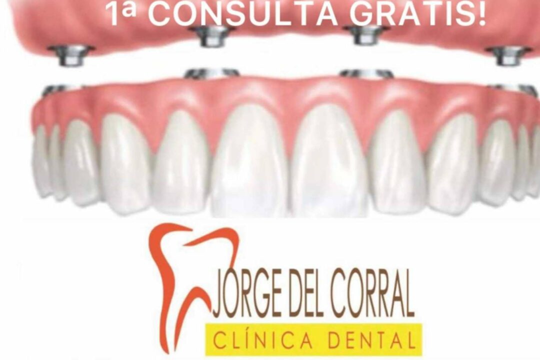 La solución definitiva en implantes dentales está en Clínica Dental Jorge del Corral