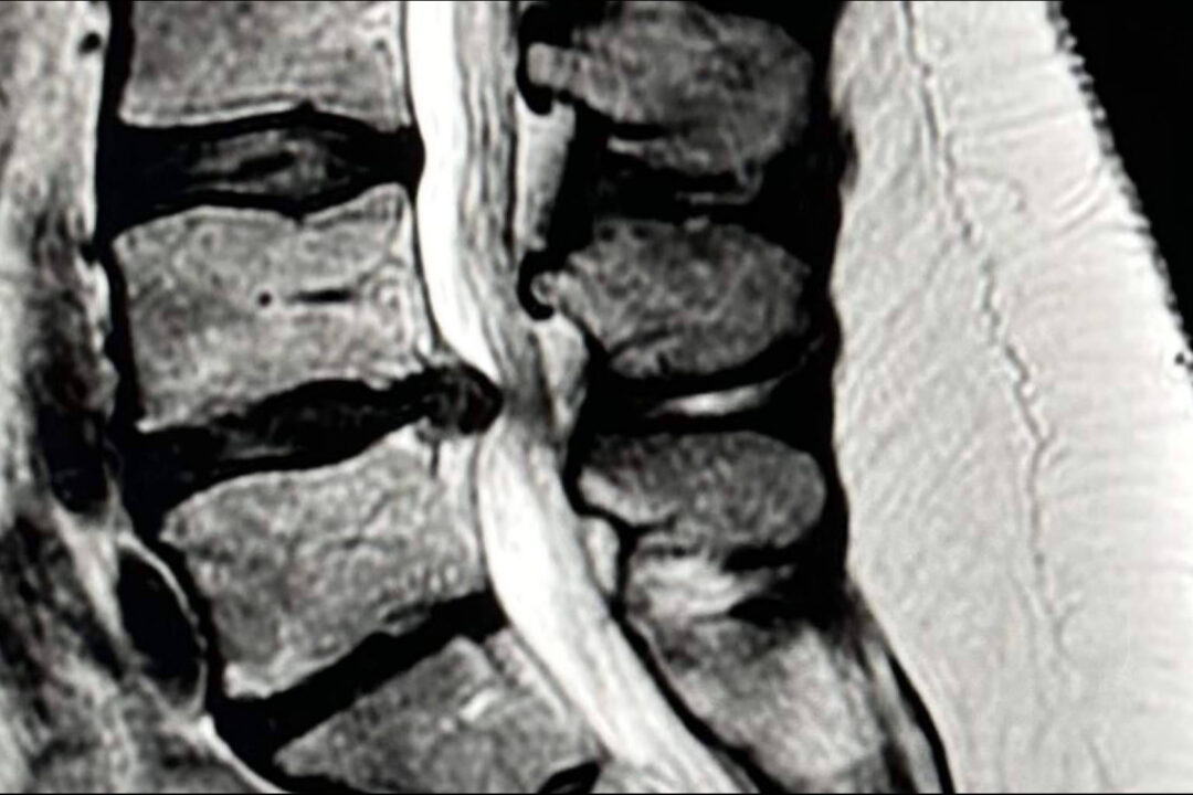 Entrevista al Dr. Botella-Asunción; Microdiscectomía vs. Discectomía endoscópica en la hernia discal lumbar