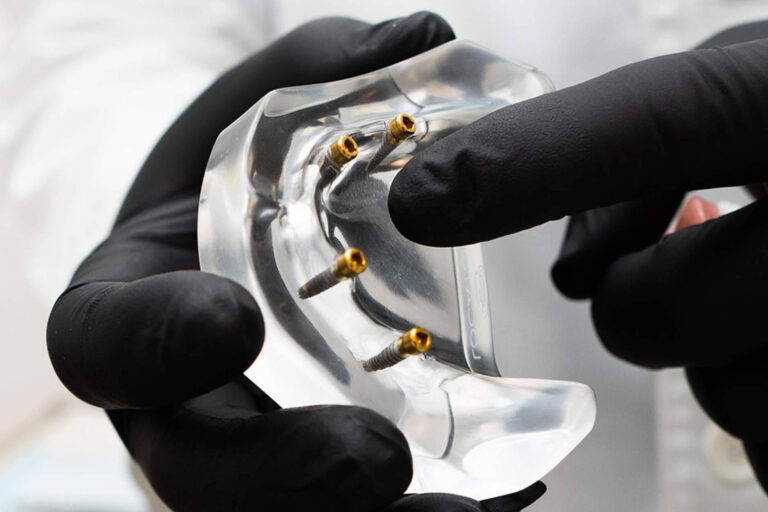 Implantes dentales de alta precisión y estética en Clínica Calvo de Mora, referencia en Madrid