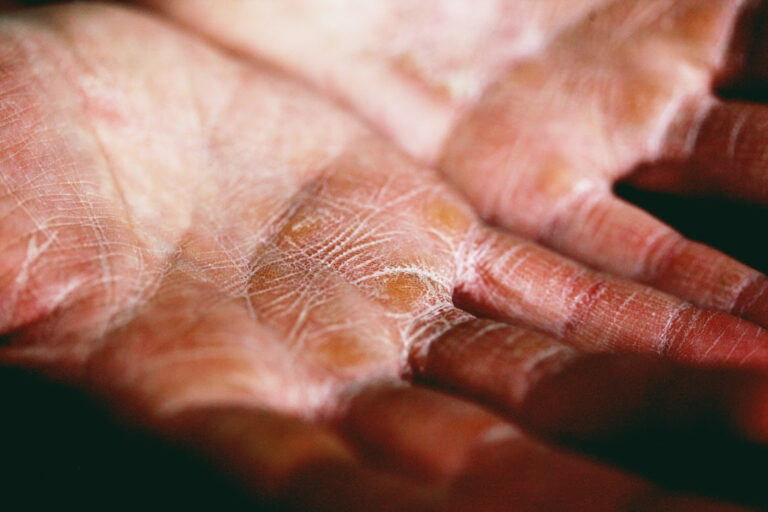 DermControl, la crema que transforma el cuidado de la piel atópica