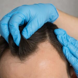 Técnica de trasplante capilar con densidad máxima y efecto natural, últimas plazas en Clínica Capilar Mora