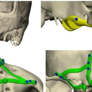 Implantes subperiósticos; la tecnología 3D abre nuevas vías para la rehabilitación dental en maxilares severamente atróficos