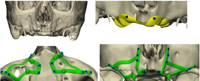 Implantes subperiósticos; la tecnología 3D abre nuevas vías para la rehabilitación dental en maxilares severamente atróficos