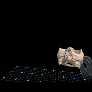 Implantes subperiósticos; la tecnología 3D abre nuevas vías para la rehabilitación dental en maxilares severamente atróficos